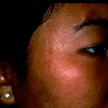 太田母斑 病気から選ぶ 実績多数の はなふさ皮膚科へ