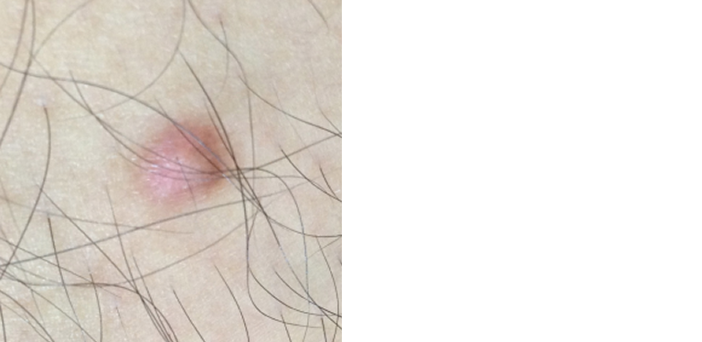 ほくろ除去 治療は保険適用可能の 三鷹はなふさ皮膚科