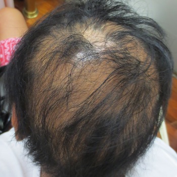 円形脱毛症に対するharg療法 症例 実績多数の はなふさ皮膚科へ