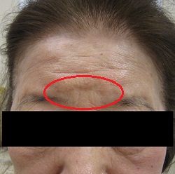 ヒアルロン酸注入による眉間の陥凹の治療 症例 実績多数の はなふさ皮膚科へ