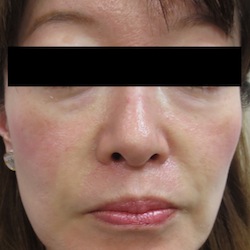 新しいヒアルロン酸を使った目の下のシワの治療 症例 実績多数の はなふさ皮膚科へ