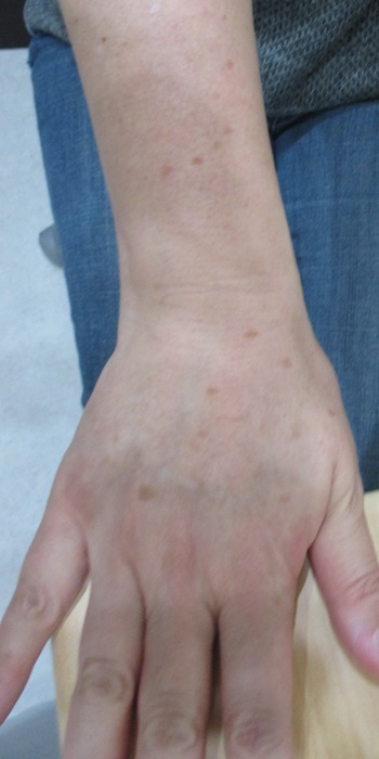 フォトによる手のシミの治療 症例 実績多数の はなふさ皮膚科へ