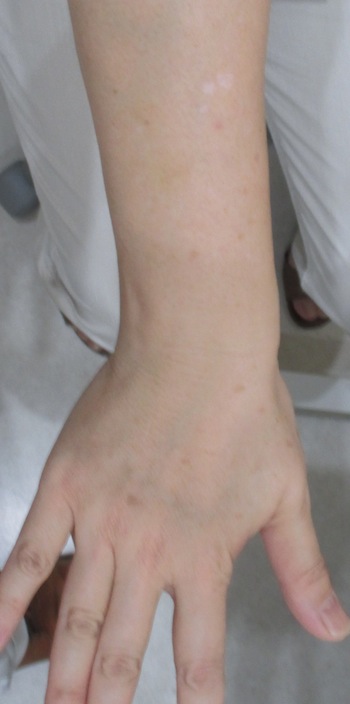 フォトによる手のシミの治療 症例 実績多数の はなふさ皮膚科へ