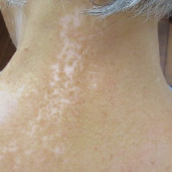 尋常性白斑でお困りの方は最新のエキシマ光線治療対応の はなふさ皮膚科 にご相談下さい