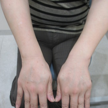 手の甲 腕のフォト治療 実績多数の はなふさ皮膚科へ