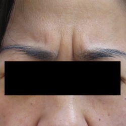 眉間のシワの治療 症例 実績多数の はなふさ皮膚科へ
