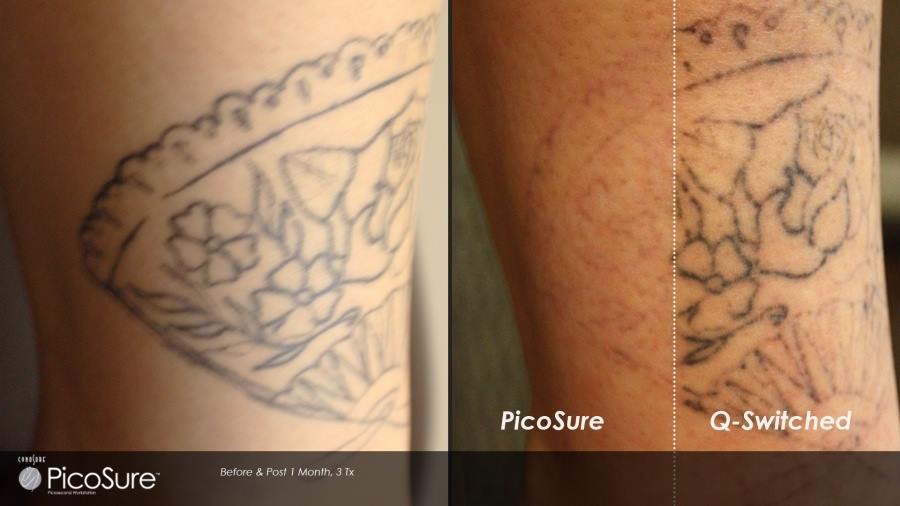 ピコレーザーによる刺青除去 実績多数の はなふさ皮膚科へ