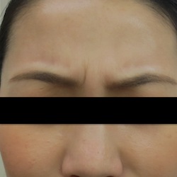 眉間のシワの治療２ 症例 実績多数の はなふさ皮膚科へ