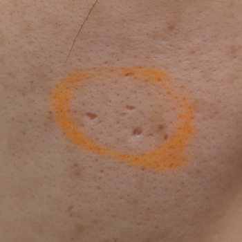 右頬のニキビ跡 アイスピック型 に対するレーザー治療 症例 実績多数の はなふさ皮膚科へ
