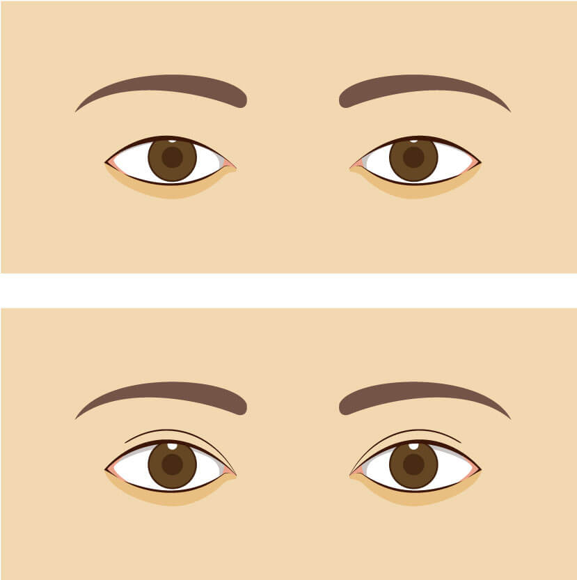 眉毛下切開術 病気から選ぶ 実績多数の はなふさ皮膚科へ